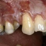 Gums Burnt by Bleaching agent