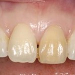 Non-vital Discolored Tooth