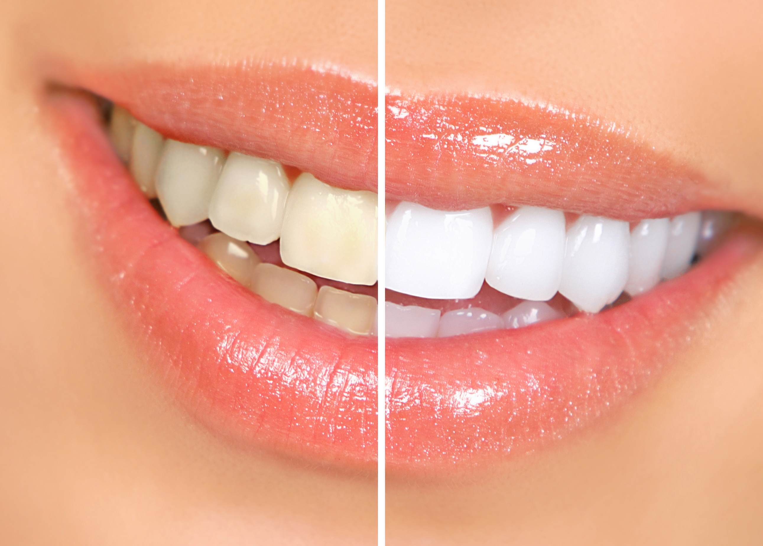 photoshop teeth whitening online