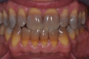 Tetracycline Teeth Staining