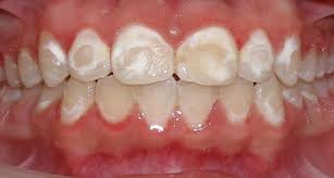 White Spots on Teeth