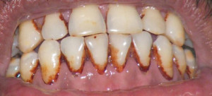 Stained Teeth