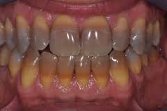 Tetracycline Stained Teeth